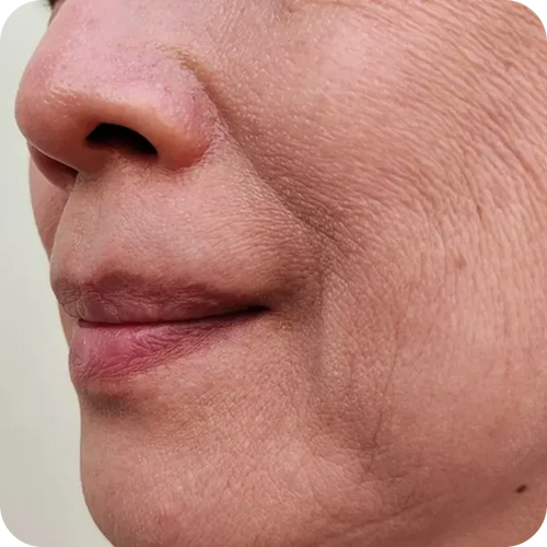 SKIN LOOKING THINNER, LOOSER, OR LESS FIRM AFTER WEIGHT LOSS